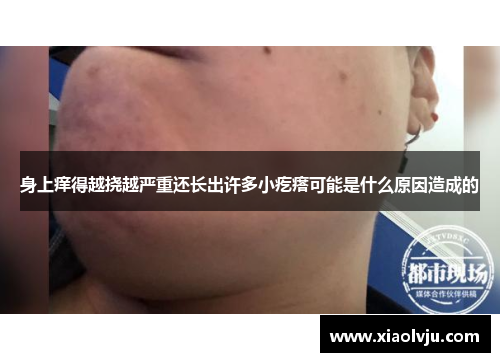 身上痒得越挠越严重还长出许多小疙瘩可能是什么原因造成的 身上痒得越挠越严重还长出许多小疙瘩可能是什么原因造成的
